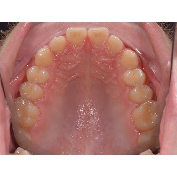 Верхний зубной ряд до лечения