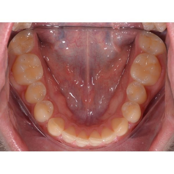 Нижний зубной ряд до лечения