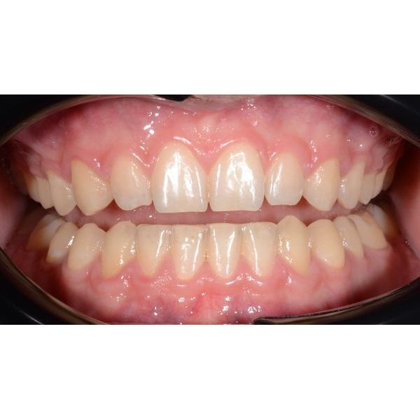 После лечения