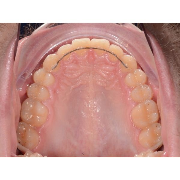 Верхний зубной ряд после лечения