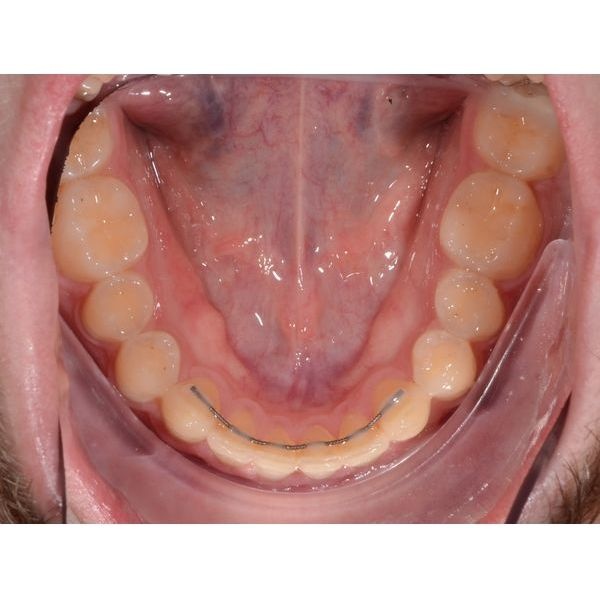 Нижний зубной ряд после лечения