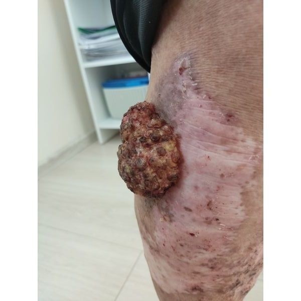 Опухоль до хирургического лечения Опухоль до хирургического лечения