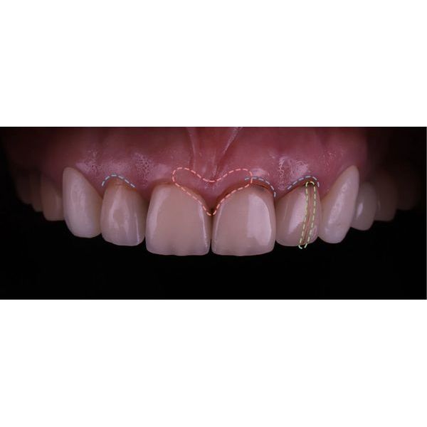 Состояние старых ортопедических конструкций Состояние старых ортопедических конструкций