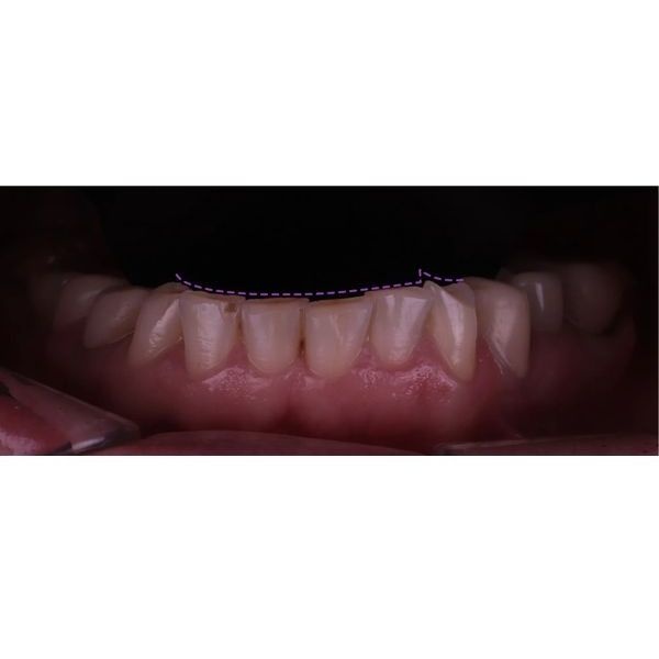 Стёртость зубов Стёртость зубов