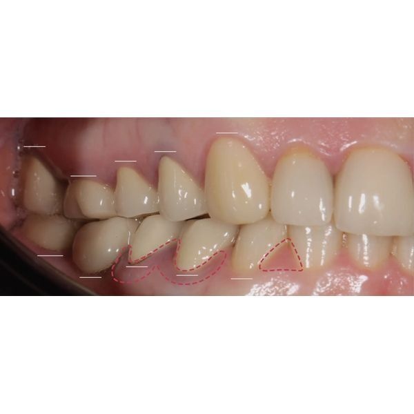 Поражение десны Поражение десны