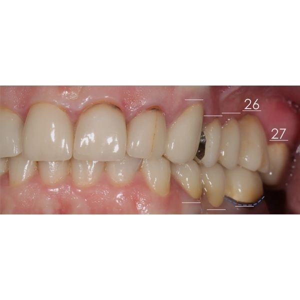 Неровный десневой контур Неровный десневой контур