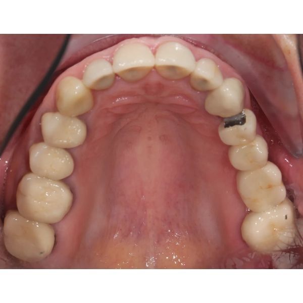 Гладкая поверхность жевательных зубов Гладкая поверхность жевательных зубов