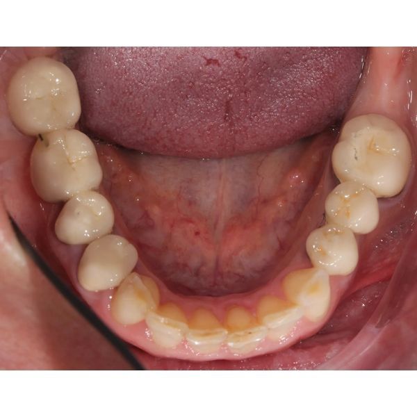 Гладкая поверхность жевательных зубов Гладкая поверхность жевательных зубов