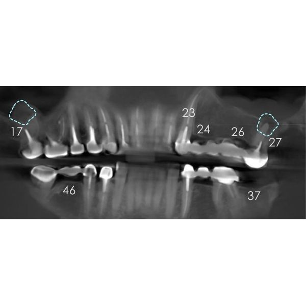 Снимок КЛКТ до лечения Снимок КЛКТ до лечения