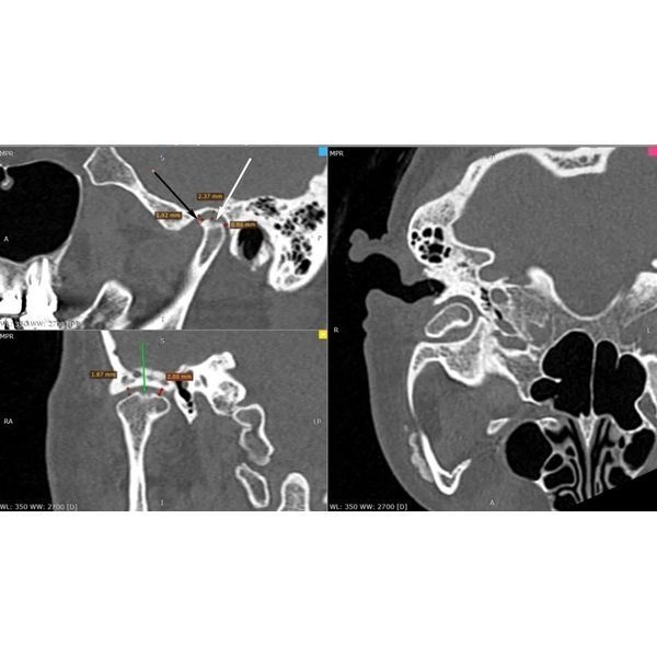 Суставная щель слева Суставная щель слева