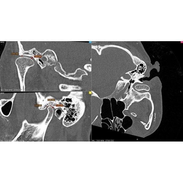 Суставная щель справа Суставная щель справа