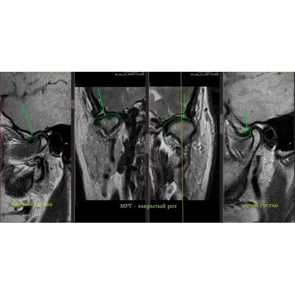 МРТ левого сустава МРТ левого сустава