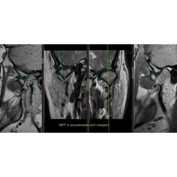 МРТ правого сустава МРТ правого сустава