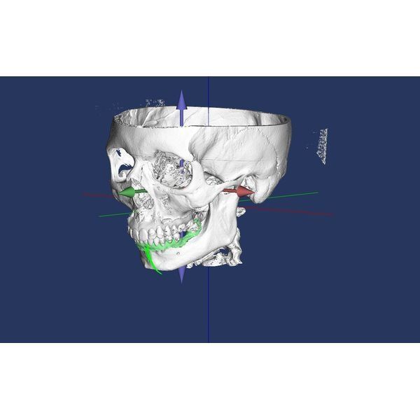 Полный вывих суставного диска Полный вывих суставного диска