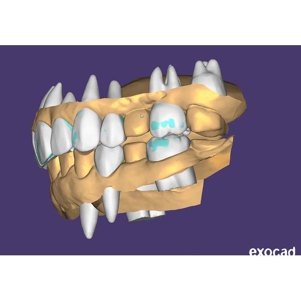 Моделирование будущих зубов Моделирование будущих зубов