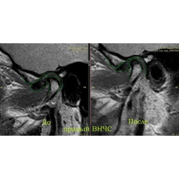 Контрольное МРТ после моделирования Контрольное МРТ после моделирования