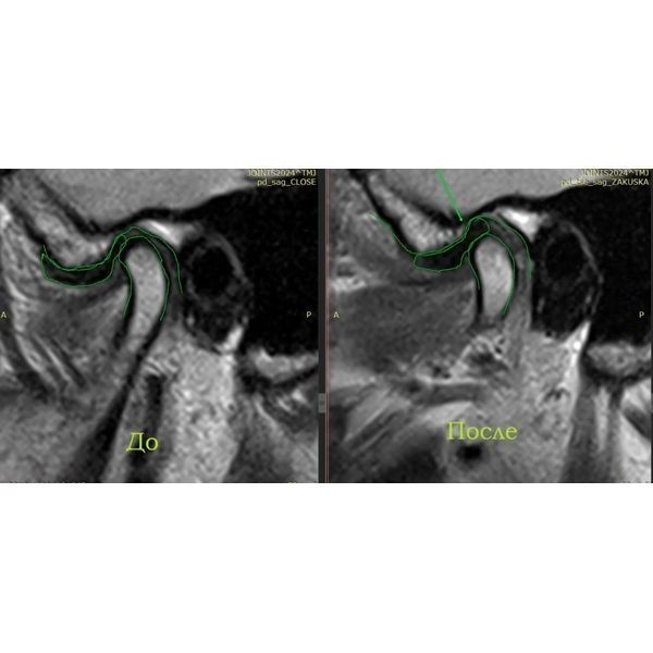 Контрольное МРТ после моделирования Контрольное МРТ после моделирования