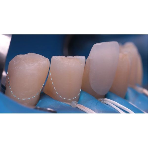 Установка ультранира Установка ультранира