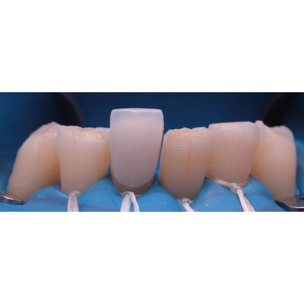 Установка ультранира Установка ультранира