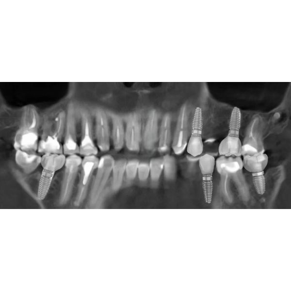 Снимок КЛКТ после лечения Снимок КЛКТ после лечения
