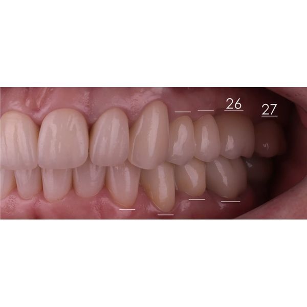 После лечения После лечения