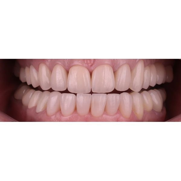 Улыбка после лечения Улыбка после лечения