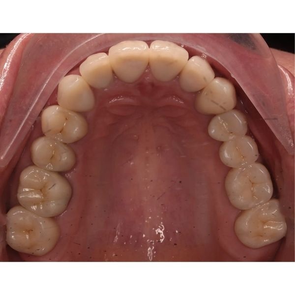 Поверхности жевательных зубов после лечения Поверхности жевательных зубов после лечения