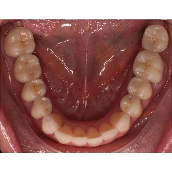 Поверхности жевательных зубов после лечения Поверхности жевательных зубов после лечения