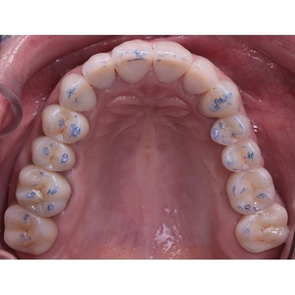 Сформированные окклюзионные контакты Сформированные окклюзионные контакты