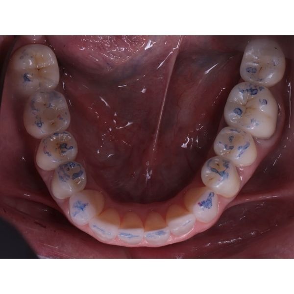 Сформированные окклюзионные контакты Сформированные окклюзионные контакты