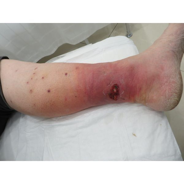 Трофическая язва до лечения в клинике