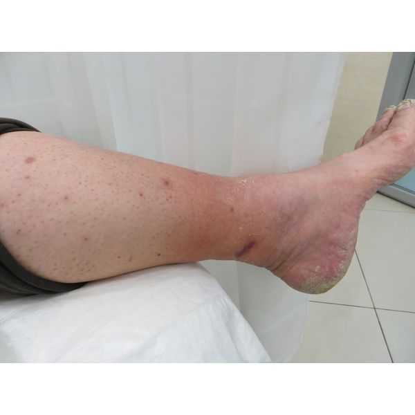 Нога через месяц после лечения в клинике