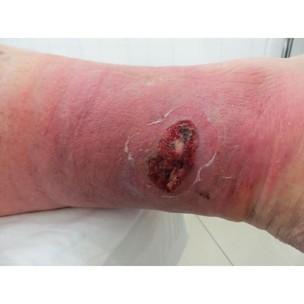 Трофическая язва до лечения в клинике