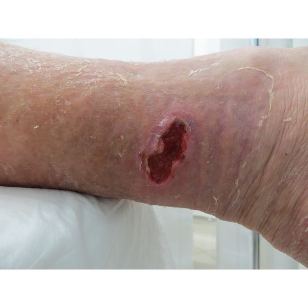 Трофическая язва через 10 дней лечения