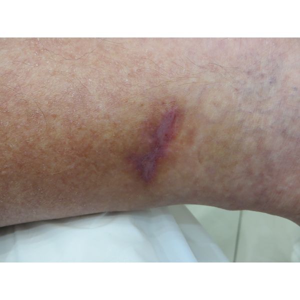 Трофическая язва через месяц лечения