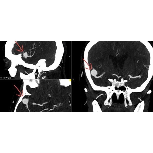 КТ-ангиография до операции