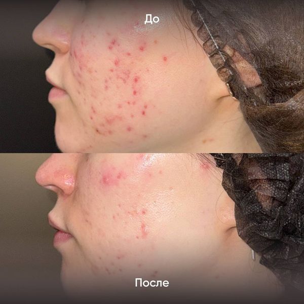 Состояние кожи лица до и после лечения