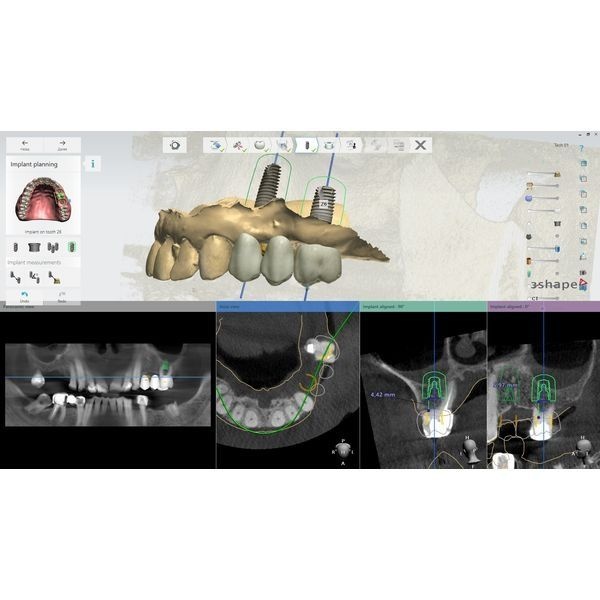3D-модель нижней челюсти с планированием лечения
