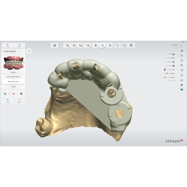3D-модель нижней челюсти с планированием лечения
