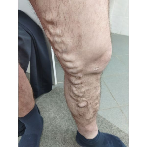 Состояние ноги до лечения Состояние ноги до лечения
