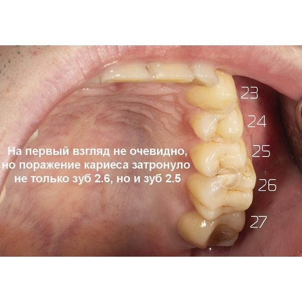 Снимок зубов 2.3–2.7 Снимок зубов 2.3–2.7