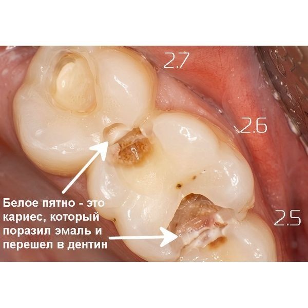 Кариес на зубах 2.5–2.7 Кариес на зубах 2.5–2.7