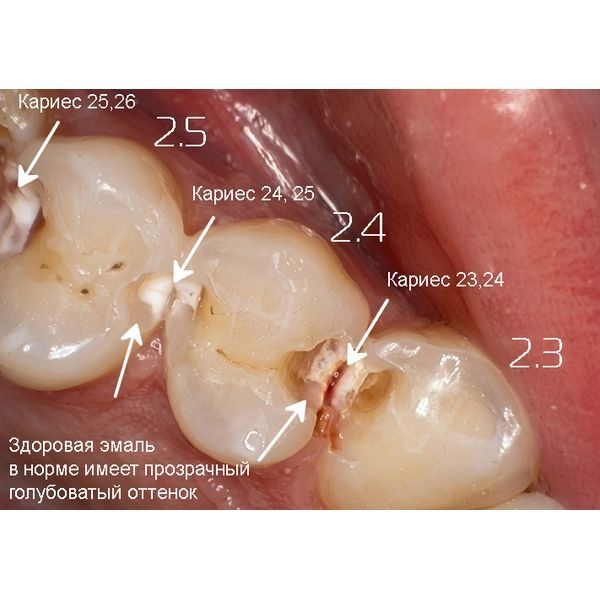 Кариес на зубах 2.3–2.6 Кариес на зубах 2.3–2.6