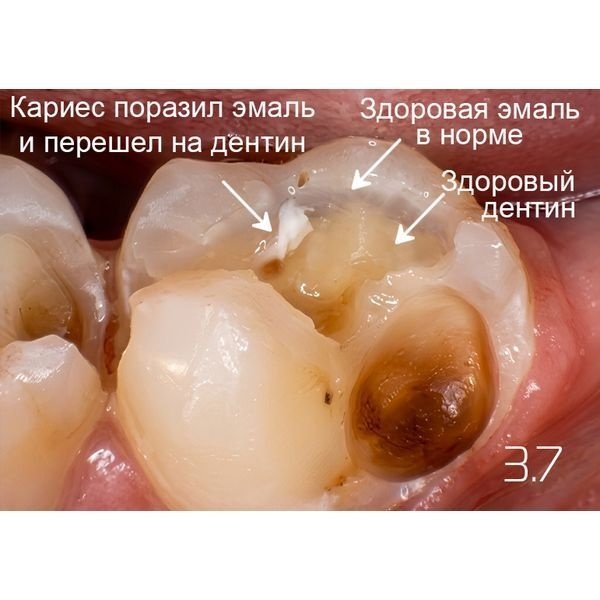 Кариес на зубе 3.7 Кариес на зубе 3.7