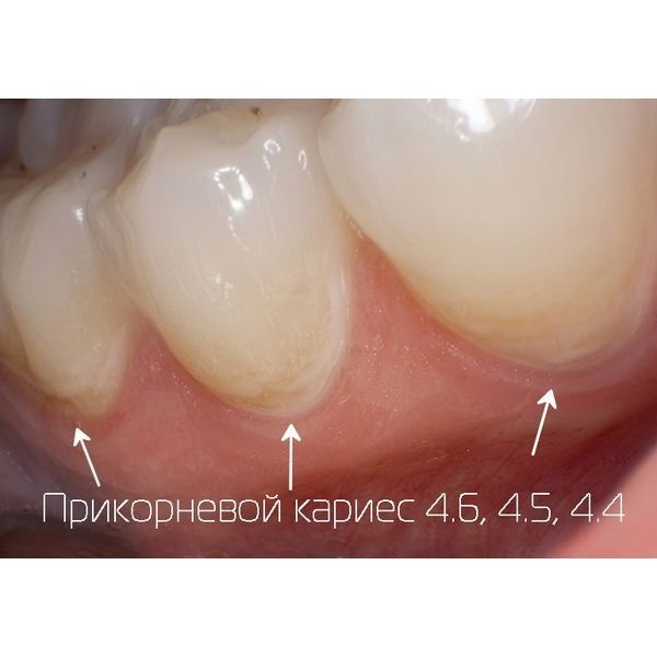 Снимок зубов 4.4–4.6 Снимок зубов 4.4–4.6