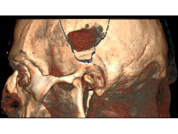 С помощь инструмента "Нож" убран костный участок черепа в проекции внутримозговой гематомы С помощь инструмента "Нож" убран костный участок черепа в проекции внутримозговой гематомы