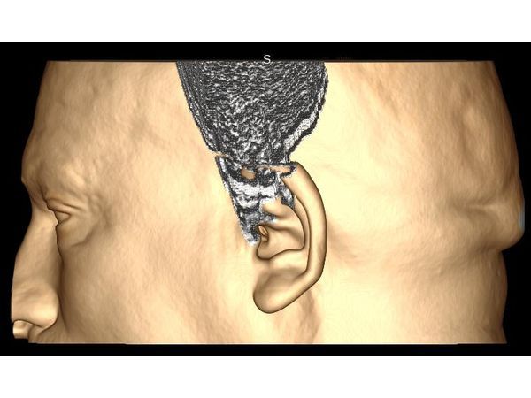 Выполнена цветокоррекция для привязки проекции гематомы на мягкие ткани головы Выполнена цветокоррекция для привязки проекции гематомы на мягкие ткани головы