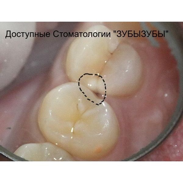 До лечения