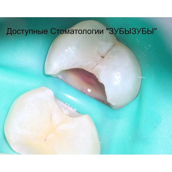 Вскрытие кариозной полости