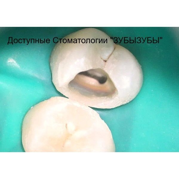 Восстановление стенки зуба 2.4